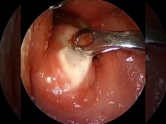 Current ≤1.5mA Arthroscopy RF Plasma Wand Surgical Equipments Shoulder Hip Knee